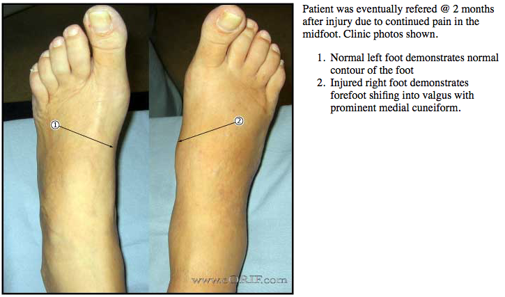 right midfoot lisfranc injury icd 10